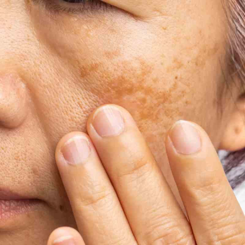 májfoltok kialakulása, kezelése, dermaonline.hu májfoltok kialakulása, kezelése, dermaonline.hu