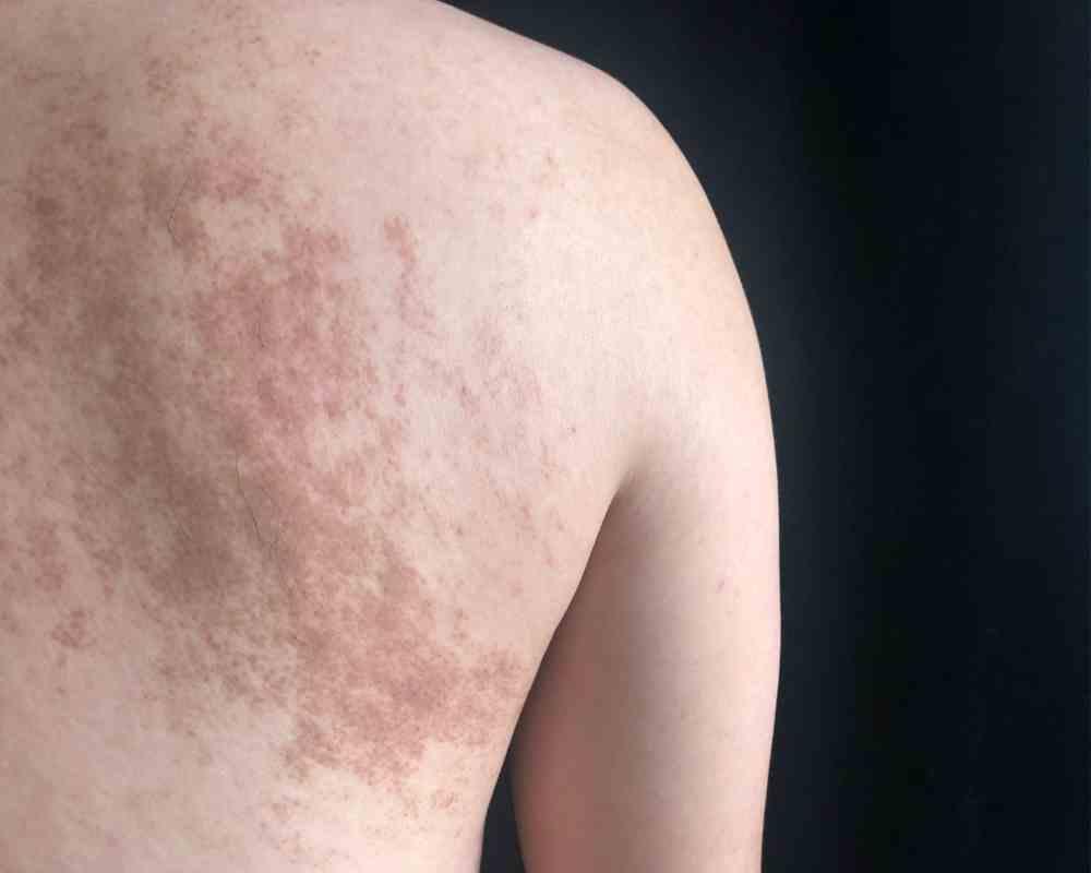 májfolt, hiperigmentáció, házi praktikák májfolt, hiperigmentáció, házi praktikák