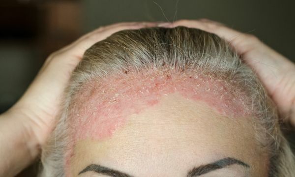 A felnőtt koszmó egy gyakori bőrbetegség, ami főleg a fejbőrt érinti