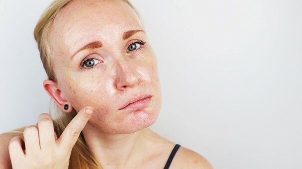 A fényvédő zsíros bőrre a szépségápolási rutin legfontosabb része, ha zsírosodásra hajlamos a bőröd.