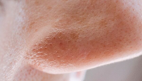 Akiknek zsírosabb a bőre, a faggyú besűrűsödik és ez okozza a bőrproblémákat