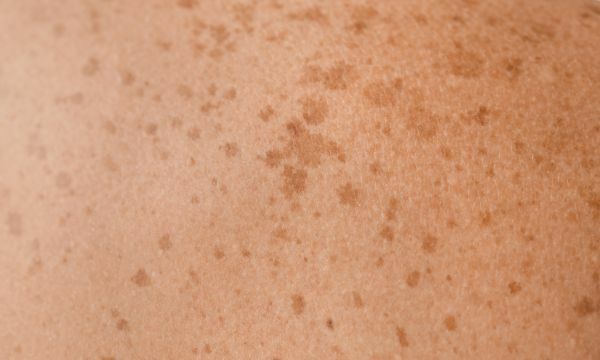 A pigmentfoltok kisebb elszíneződések a bőr felszínén